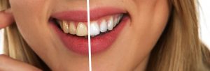 Dangers of “Do-It-Yourself” Teeth Whitening