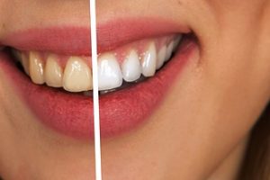 Dangers of “Do-It-Yourself” Teeth Whitening